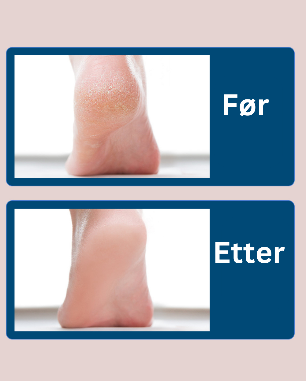 Flawless Feet - Få De Glatteste Føttene Med Vår Elektriske Fotfil! - Nå Med 50 % RABATT!